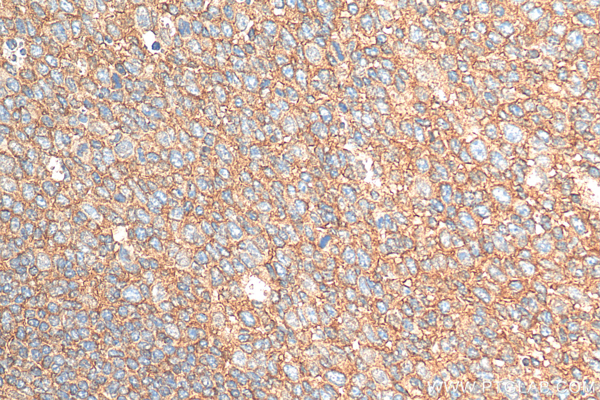 IHC staining of human tonsillitis using 12259-1-AP