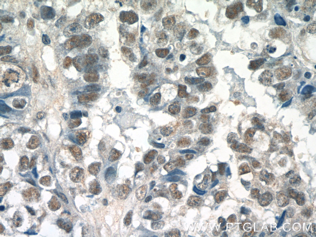 IHC staining of human breast cancer using 55005-1-AP