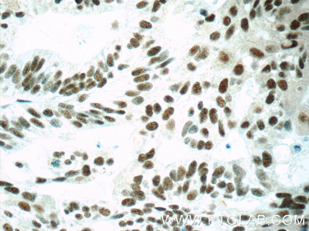 IHC staining of human ovary tumor using 55005-1-AP