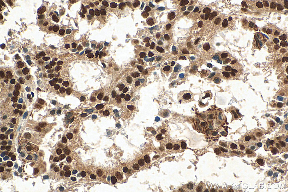 IHC staining of human ovary tumor using 55005-1-AP