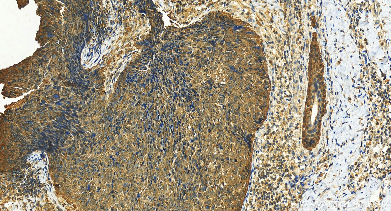 IHC staining of human bowen disease using 10622-1-AP