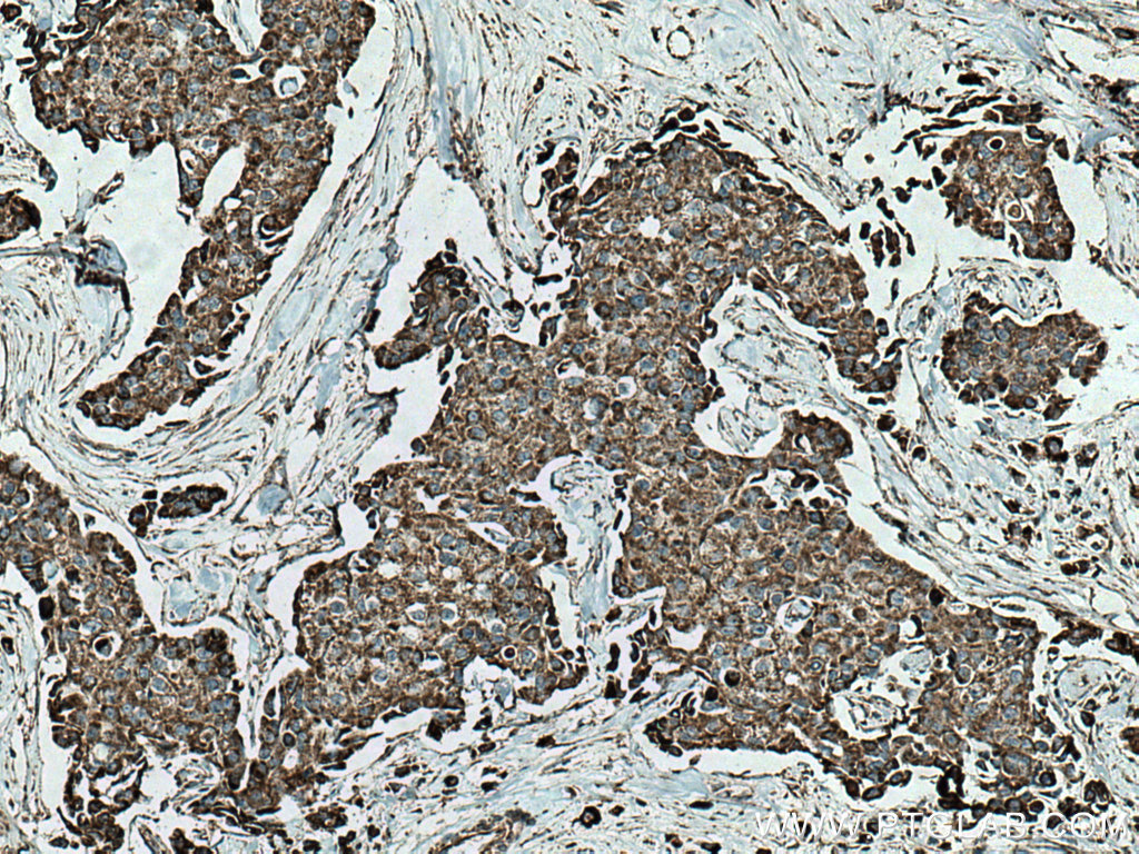 IHC staining of human breast cancer using 12296-1-AP