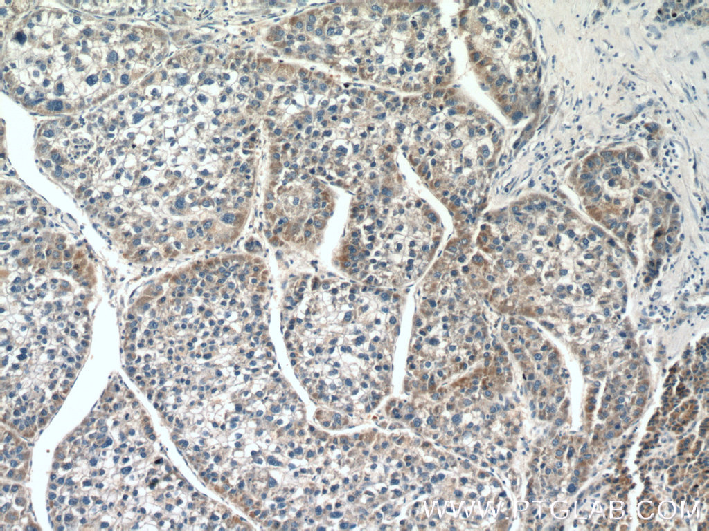 IHC staining of human liver cancer using 22100-1-AP