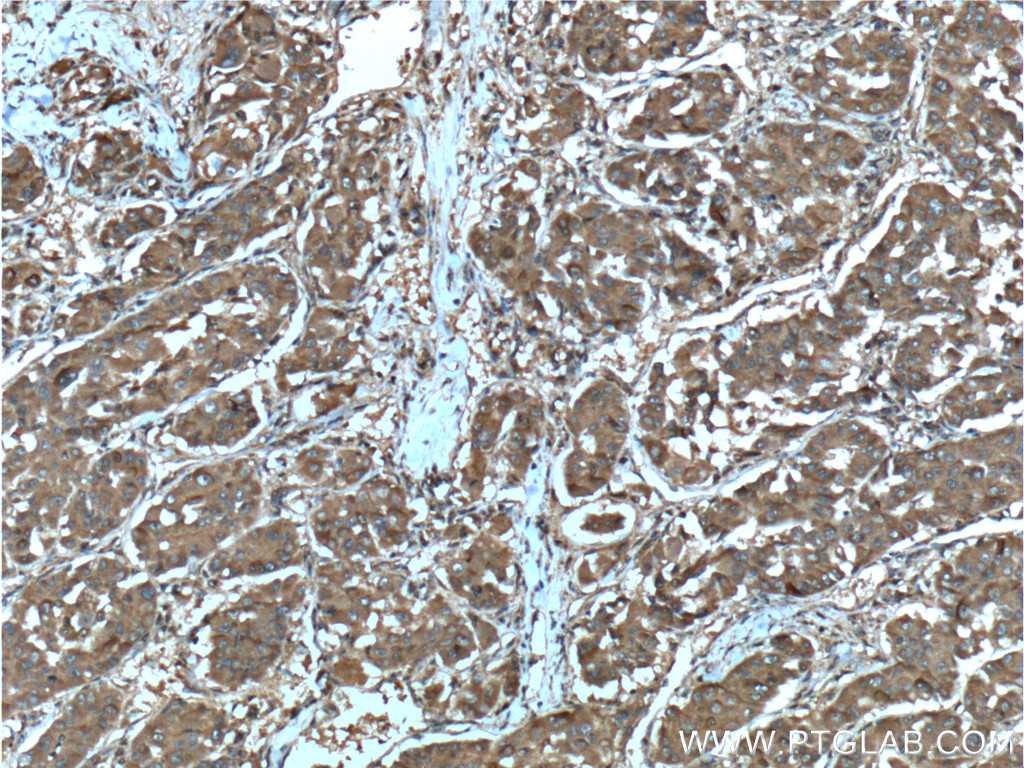 IHC staining of human liver cancer using 60305-1-Ig (same clone as 60305-1-PBS)