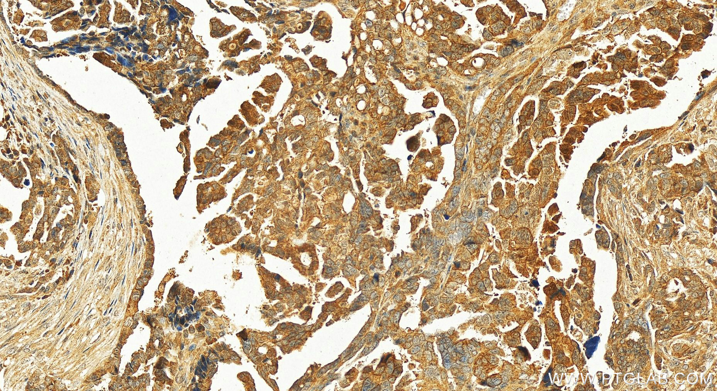 IHC staining of human ovary cancer using 12226-1-AP