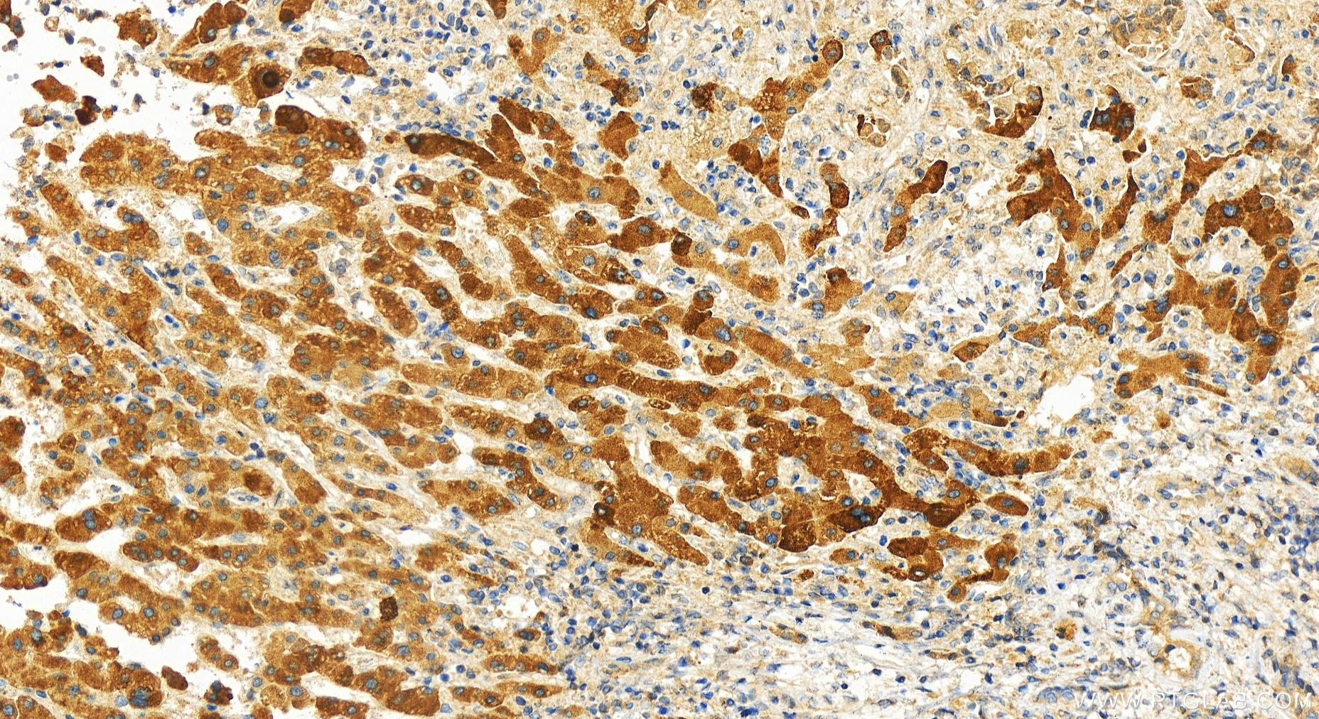 IHC staining of human intrahepatic cholangiocarcinoma using 11253-1-AP