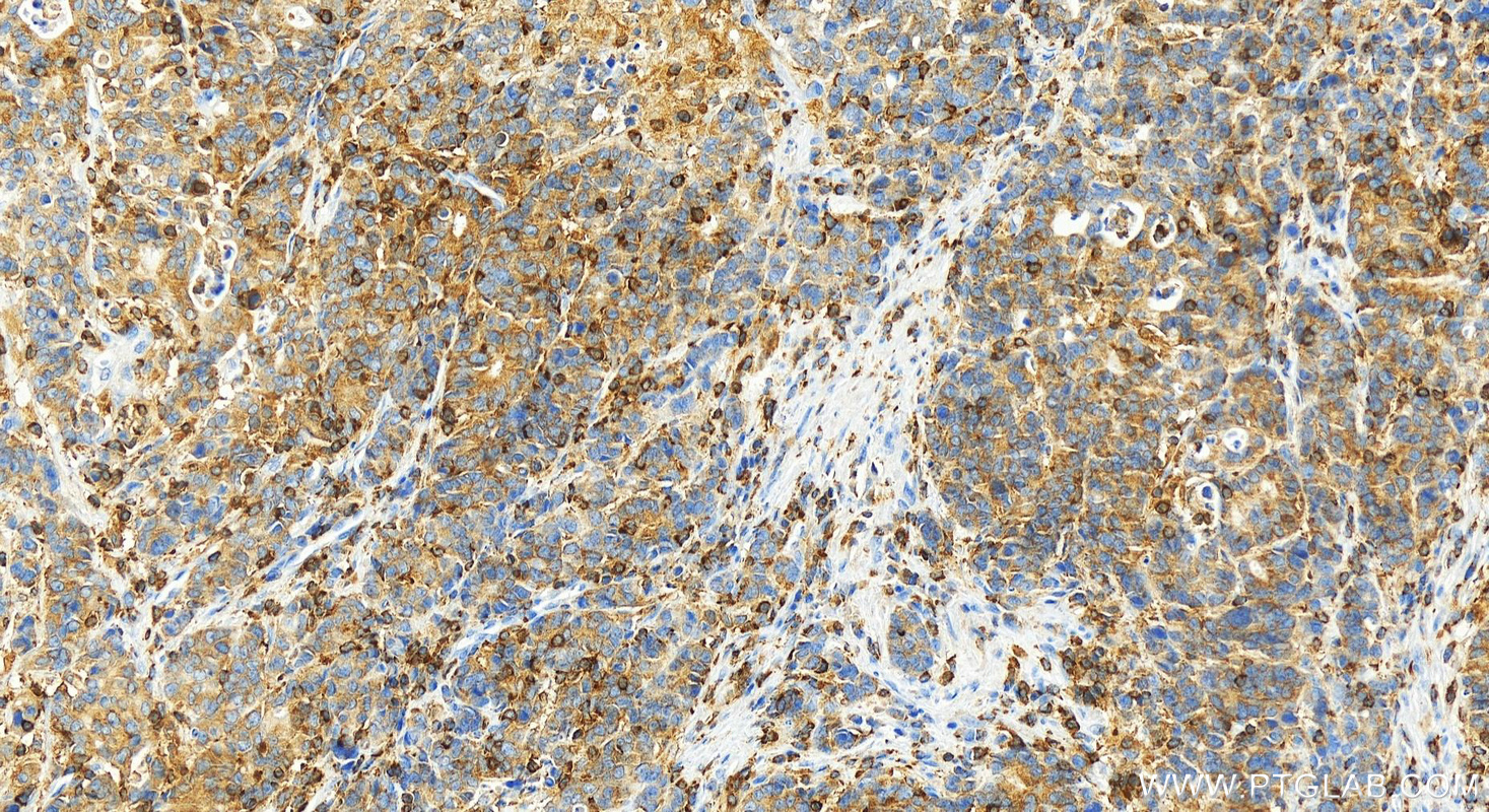 IHC staining of human stomach cancer using 20541-1-AP