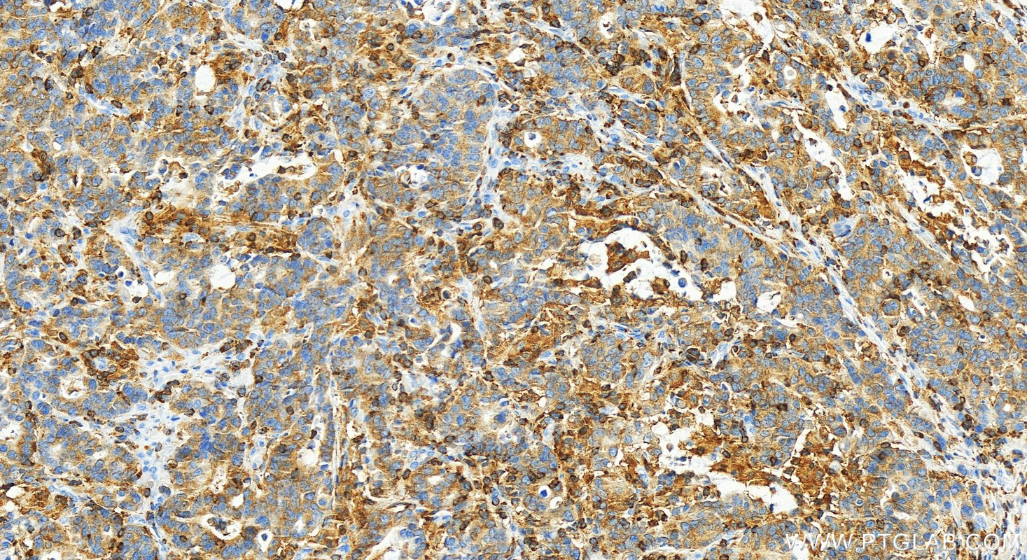 IHC staining of human stomach cancer using 20541-1-AP