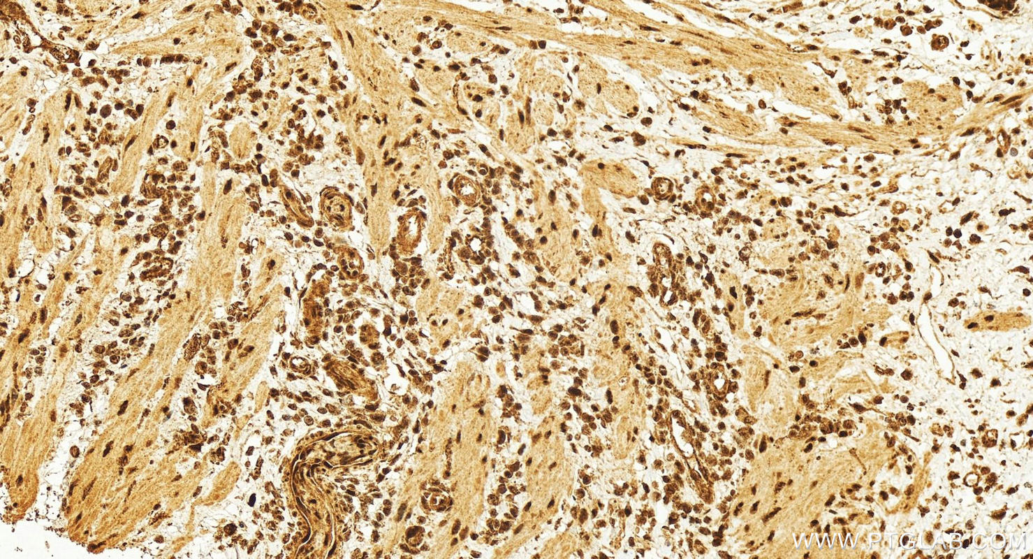 IHC staining of human colon cancer using 13306-1-AP