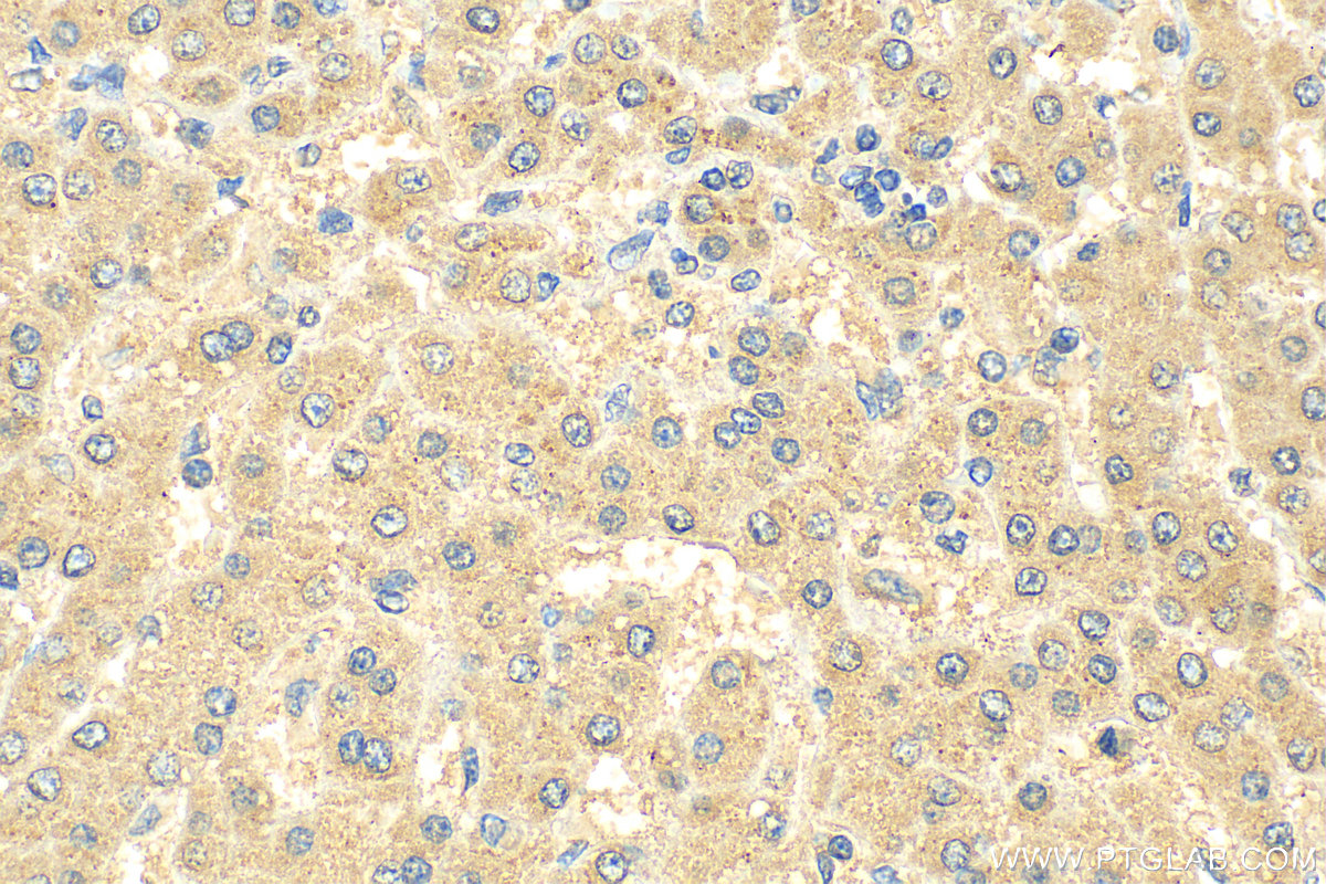 IHC staining of human liver cancer using 68647-1-Ig (same clone as 68647-1-PBS)