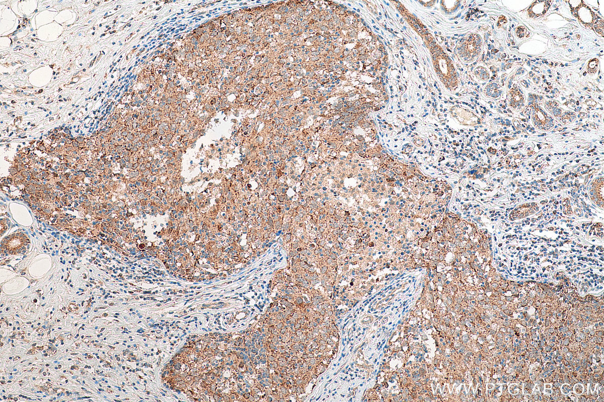 IHC staining of human breast cancer using 22902-1-AP