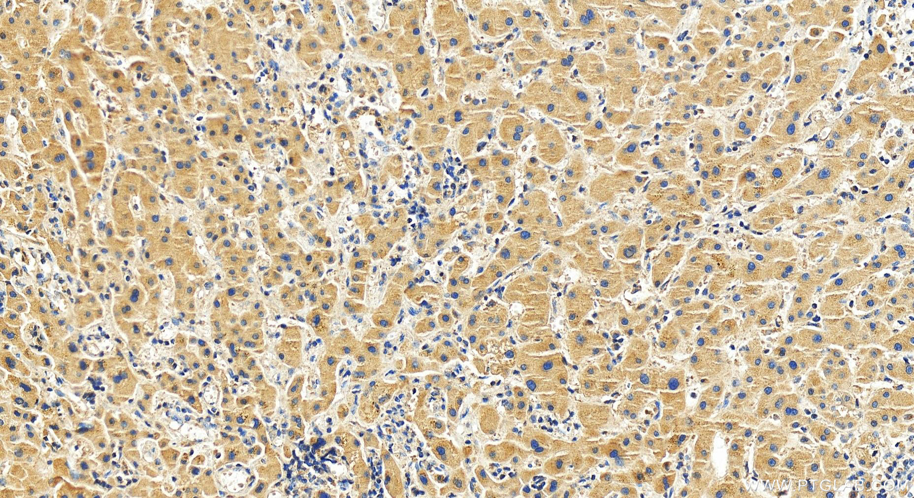 IHC staining of human intrahepatic cholangiocarcinoma using 27828-1-AP