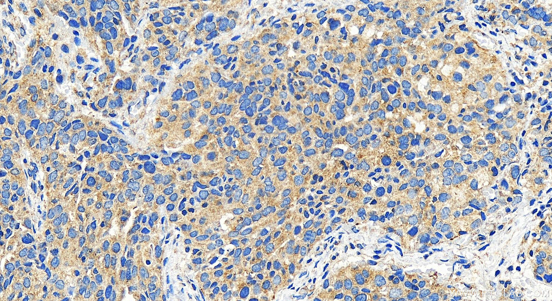 IHC staining of human ovary cancer using 27828-1-AP