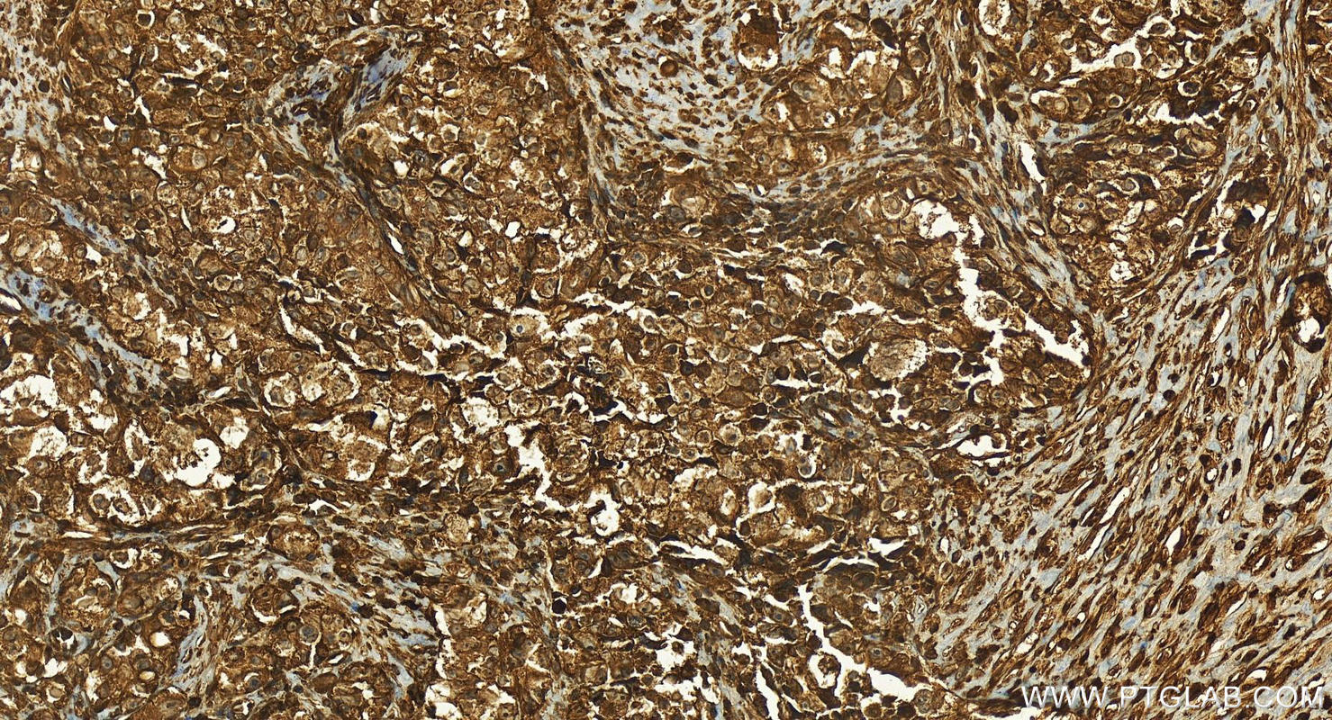 IHC staining of human ovary cancer using 26793-1-AP