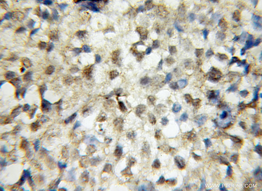 IHC staining of human ovary tumor using 12674-1-AP