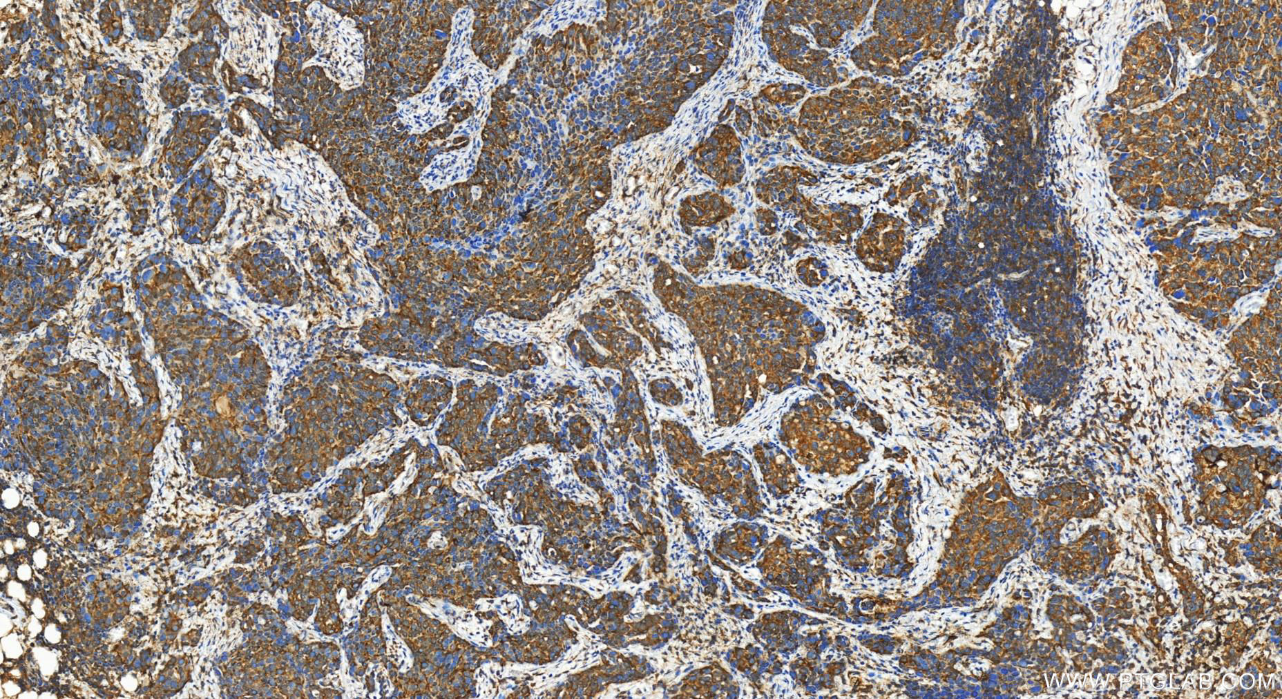 IHC staining of human ovary cancer using 30544-1-AP