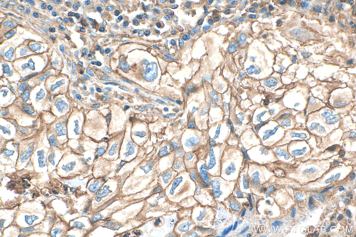 IHC staining of human lung cancer using 68206-1-Ig (same clone as 68206-1-PBS)