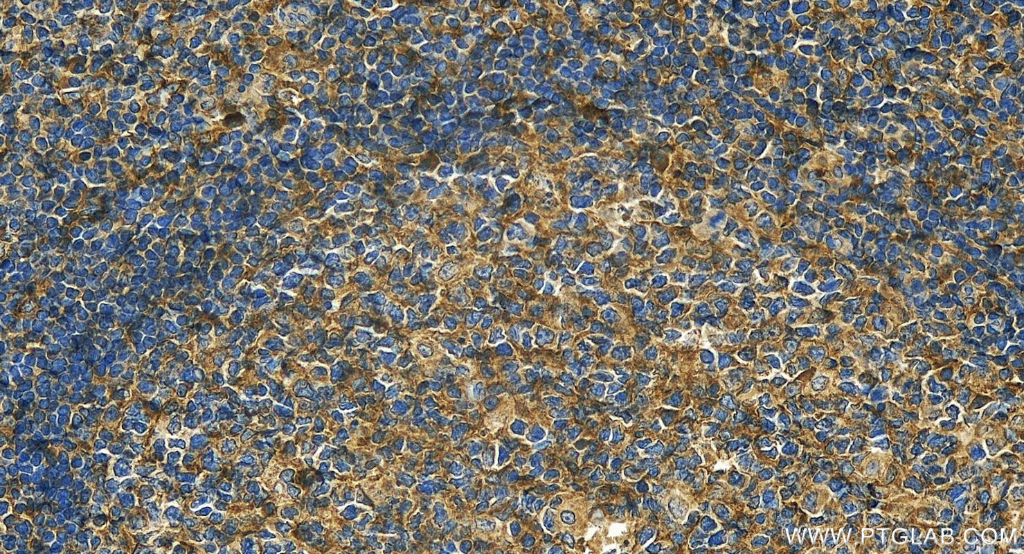 IHC staining of human tonsillitis using 14482-1-AP