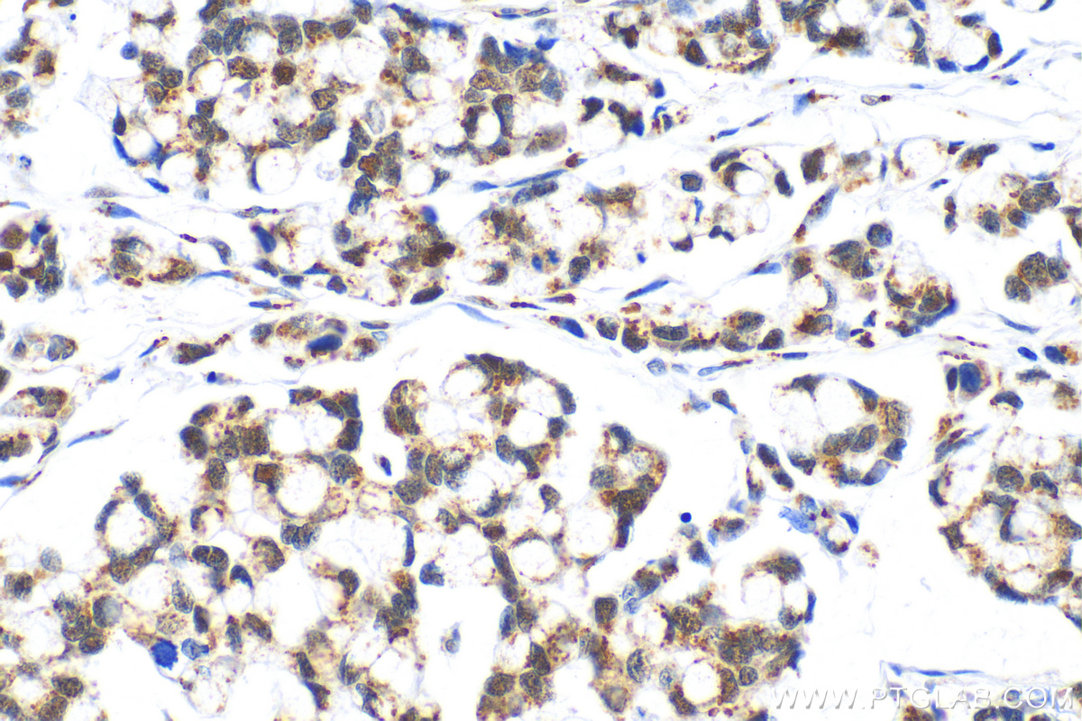 IHC staining of human colon cancer using 13161-1-AP