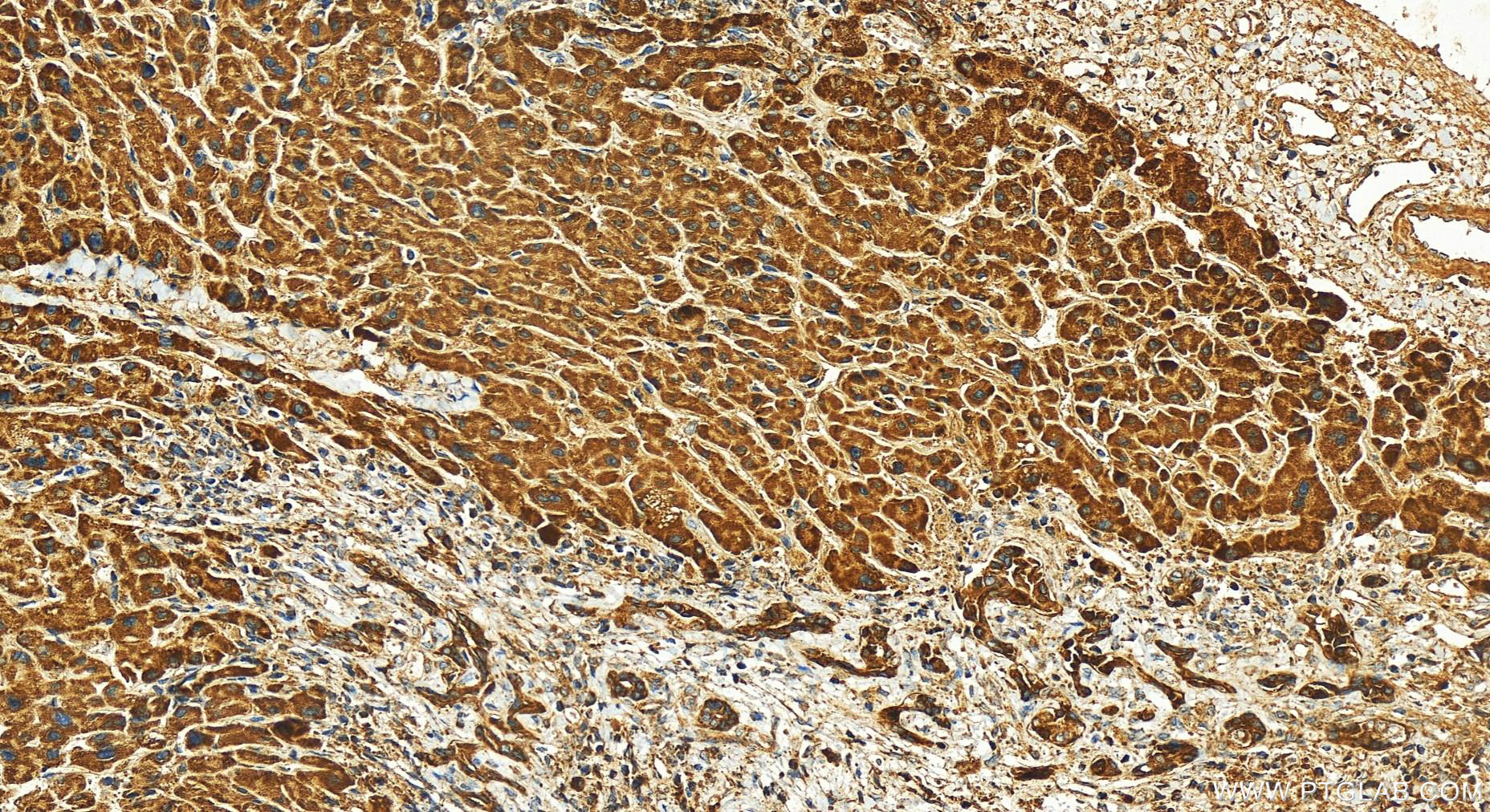 IHC staining of human intrahepatic cholangiocarcinoma using 10099-1-AP