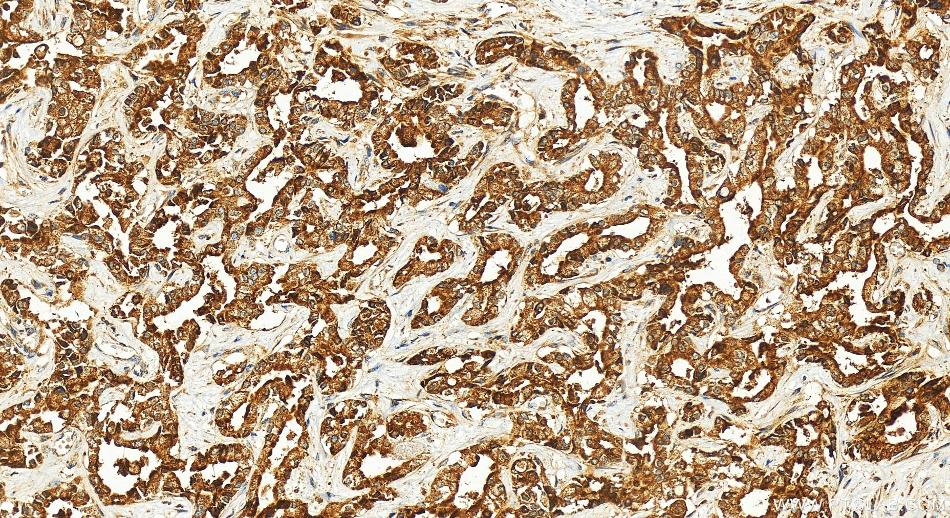 IHC staining of human intrahepatic cholangiocarcinoma using 10099-1-AP