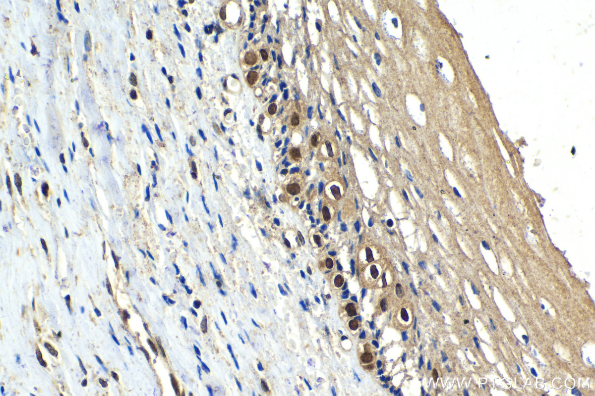 IHC staining of human cervical cancer using 21305-1-AP