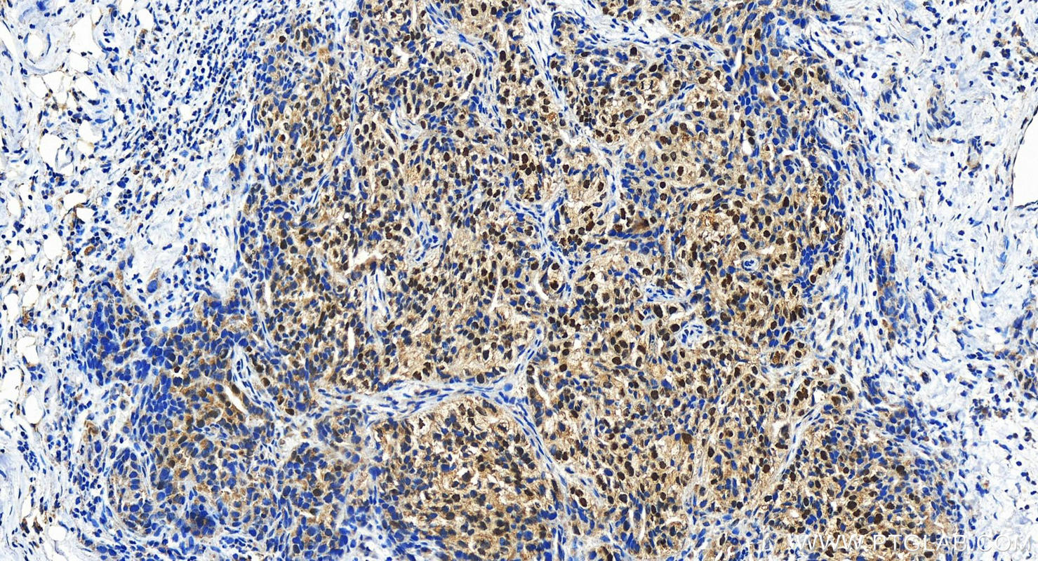 IHC staining of human ovary cancer using 21305-1-AP