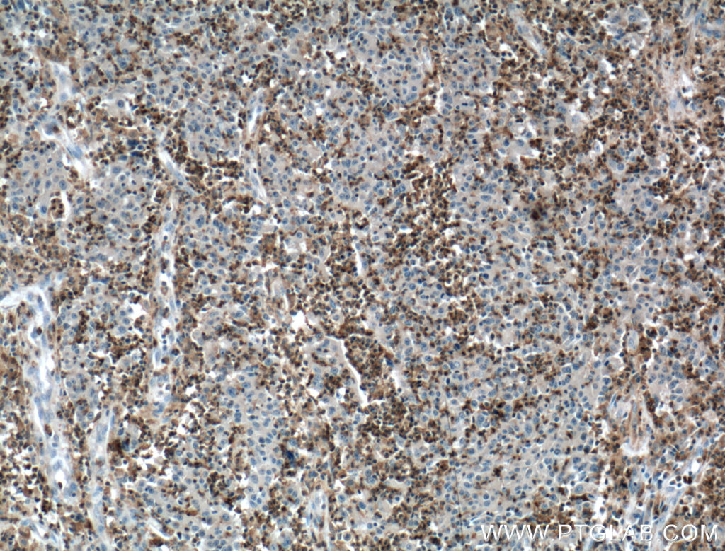 IHC staining of human colon cancer using 12926-1-AP