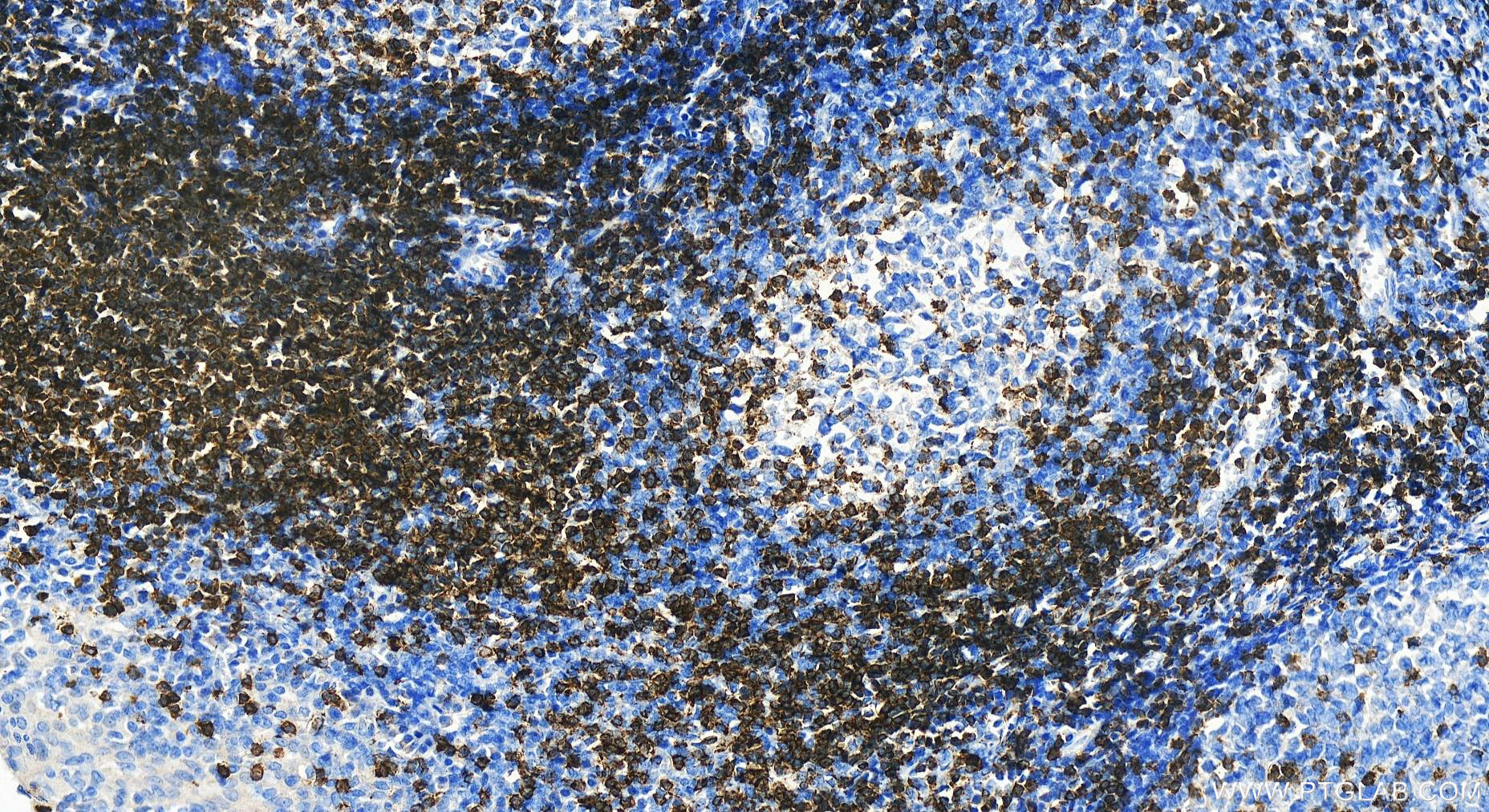 IHC staining of human tonsillitis using 14724-1-AP