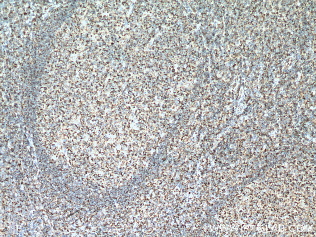 IHC staining of human tonsillitis using 22711-1-AP