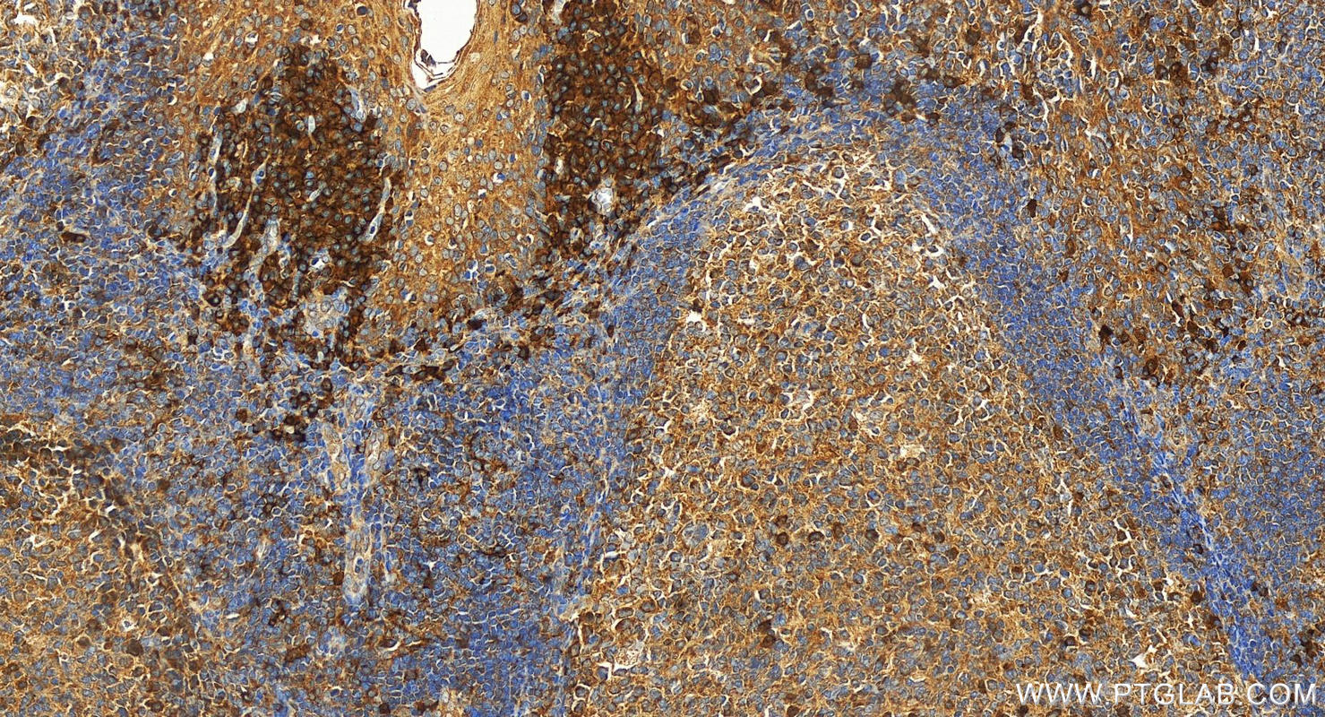 IHC staining of human tonsillitis using 12905-1-AP