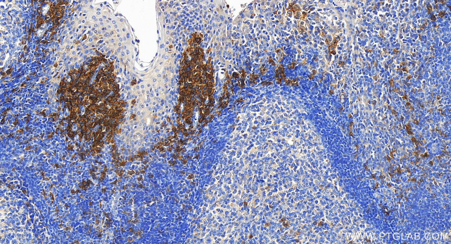 IHC staining of human tonsillitis using 30573-1-AP