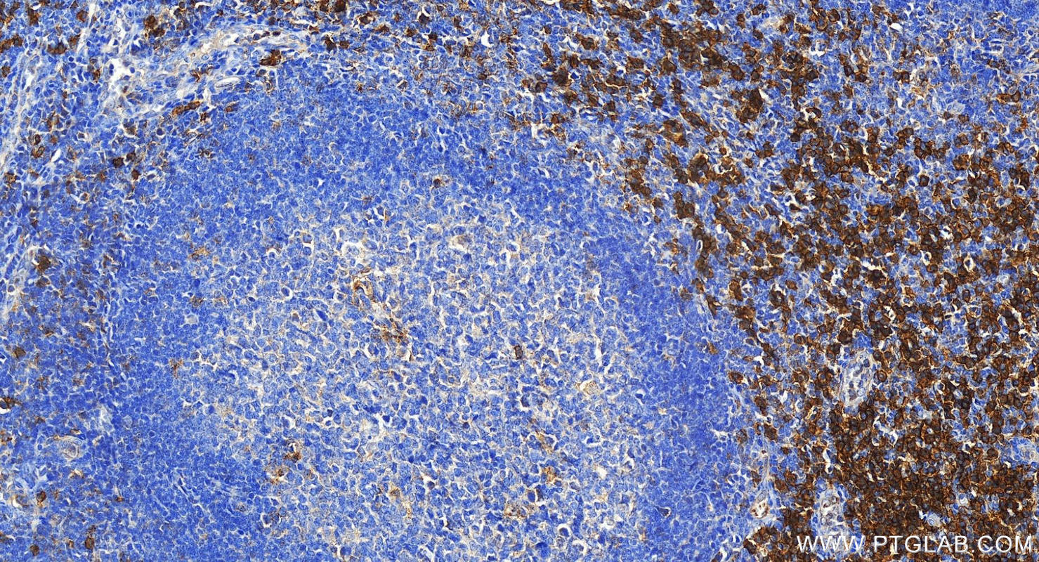 IHC staining of human tonsillitis using 30573-1-AP