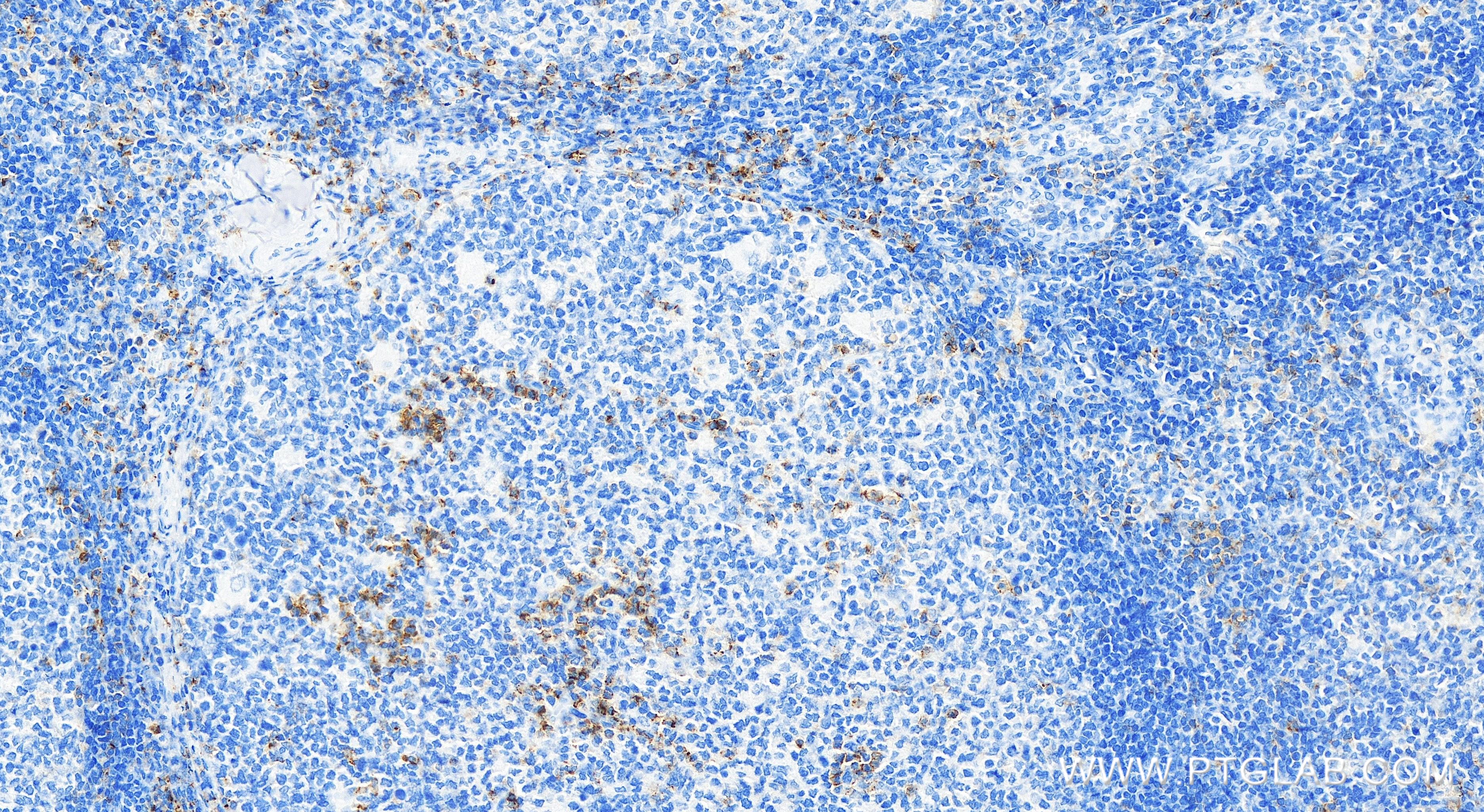 IHC staining of human tonsillitis using 84254-1-RR