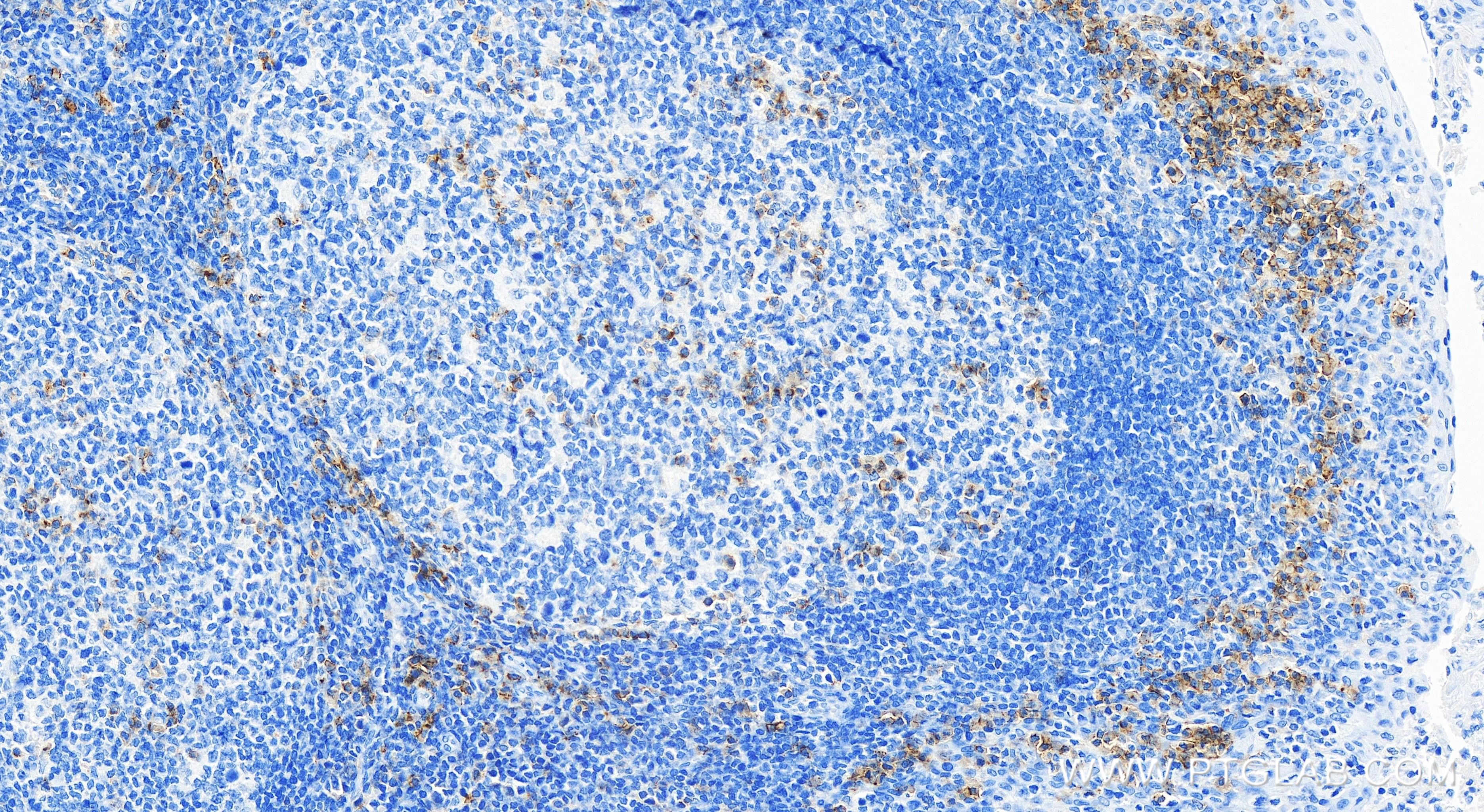 IHC staining of human tonsillitis using 84254-1-RR