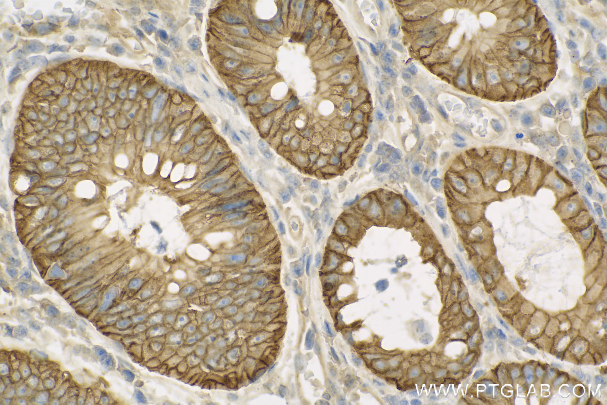 IHC staining of human colon cancer using 13884-1-AP