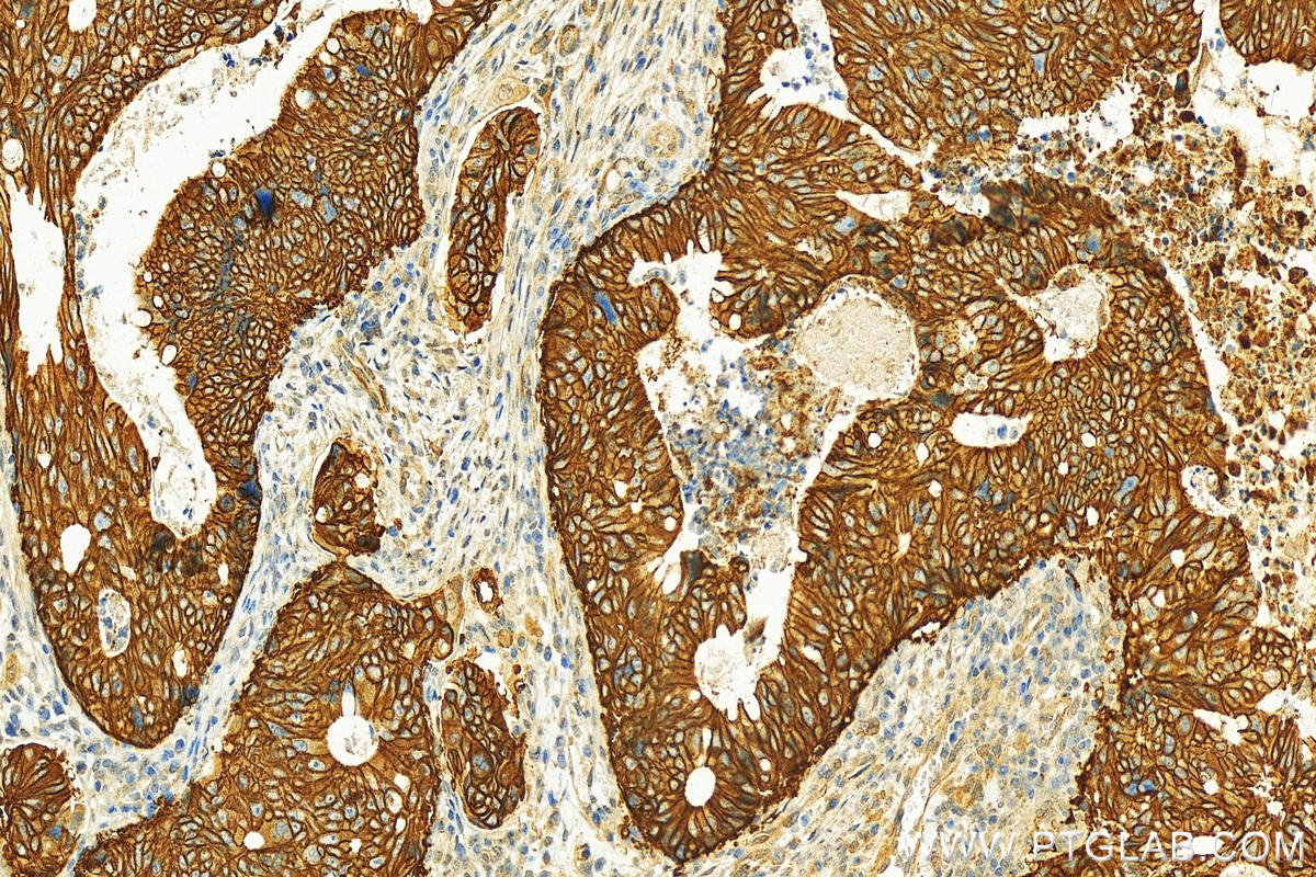 IHC staining of human colon cancer using 28055-1-AP