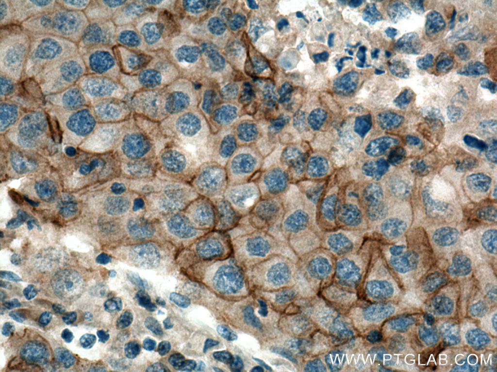 IHC staining of human breast cancer using 28055-1-AP