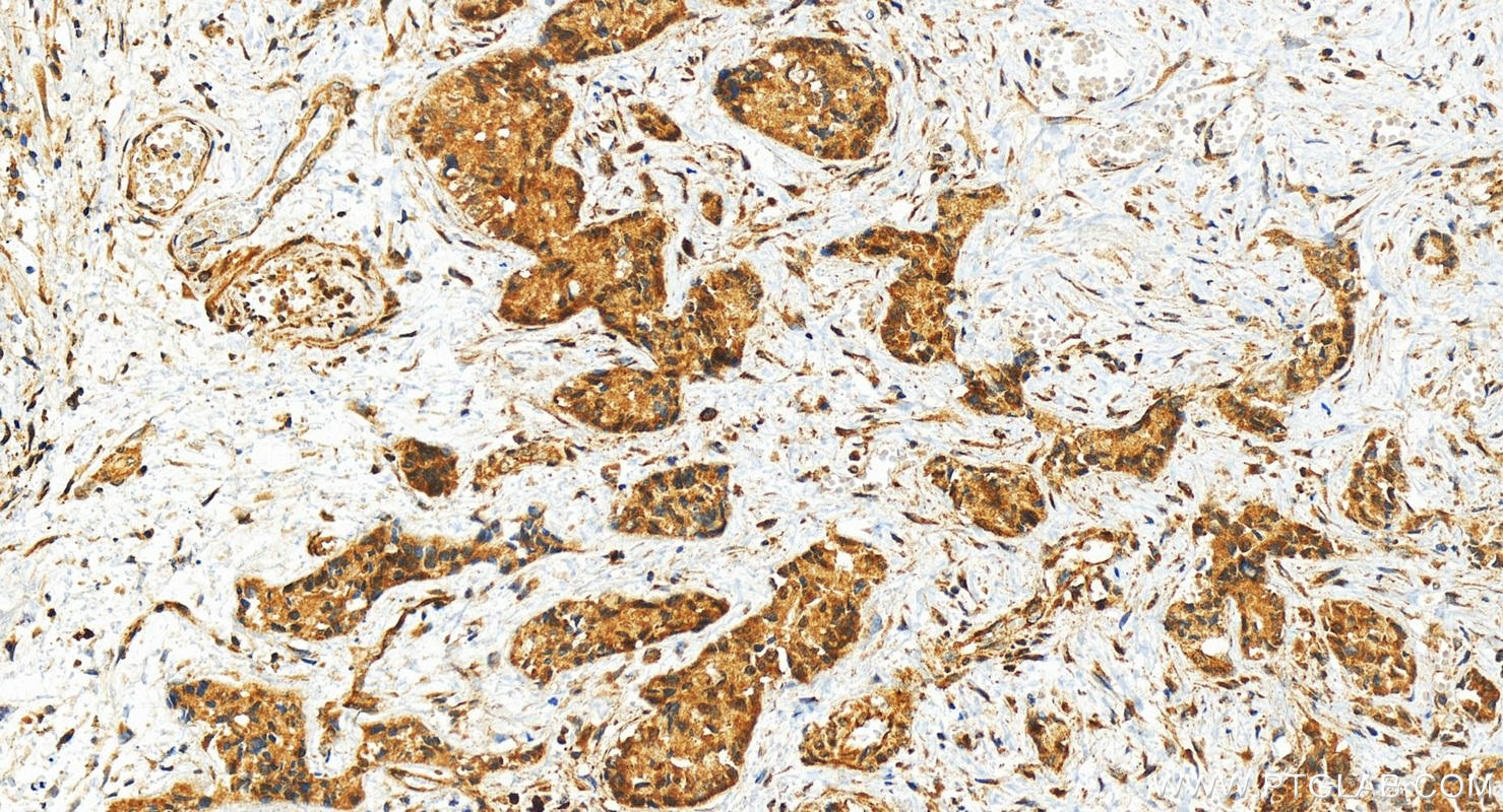 IHC staining of human intrahepatic cholangiocarcinoma using 83225-2-RR