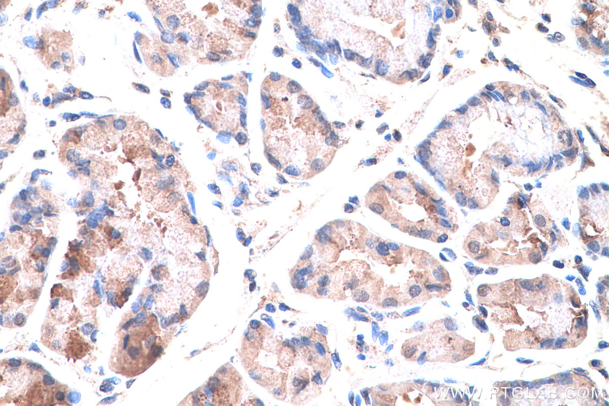 IHC staining of human stomach cancer using 20553-1-AP