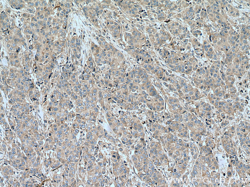 IHC staining of human breast cancer using 12120-1-AP