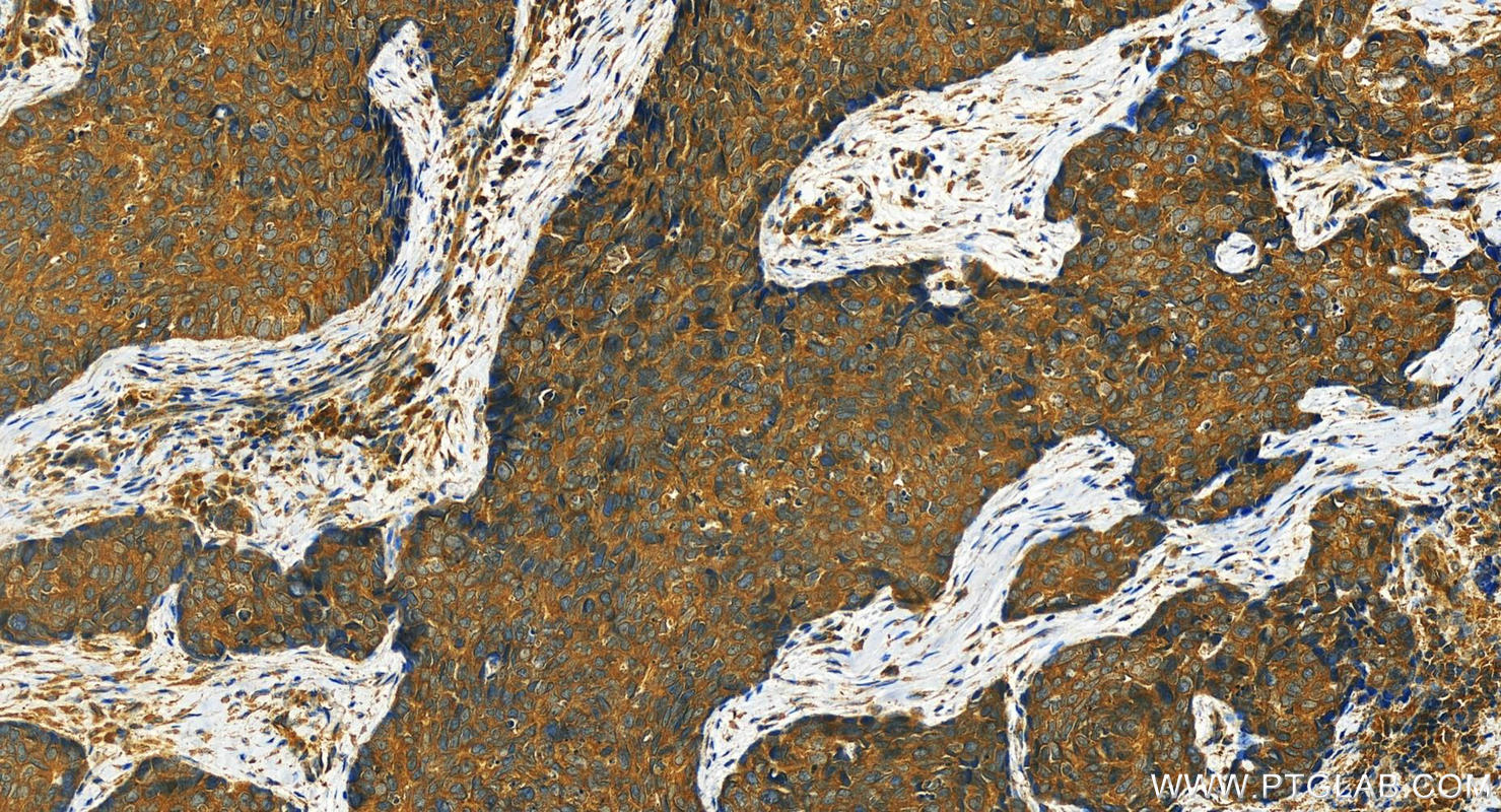 IHC staining of human bowen disease using 12820-1-AP