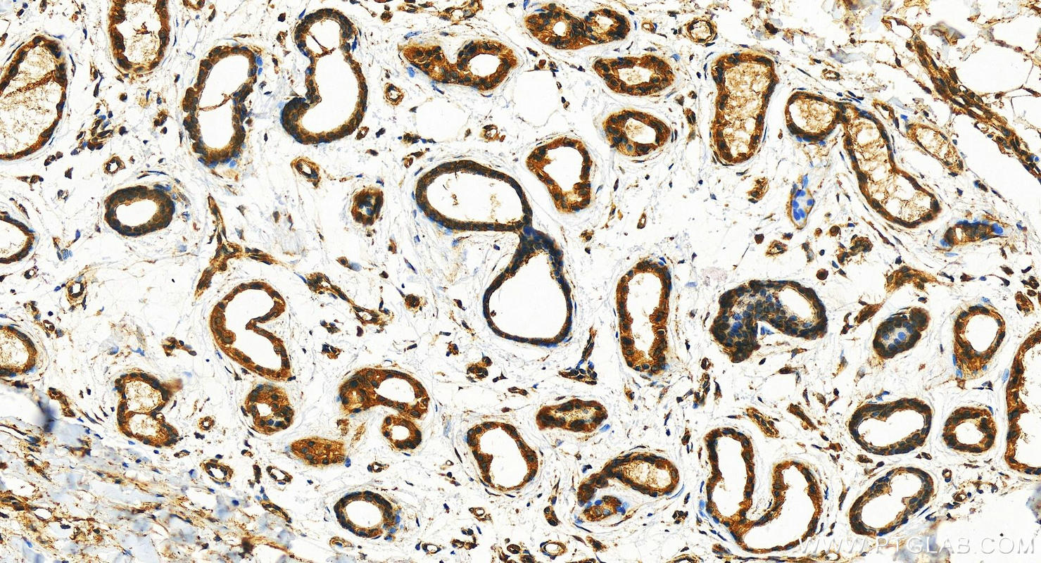 IHC staining of human bowen disease using 12820-1-AP