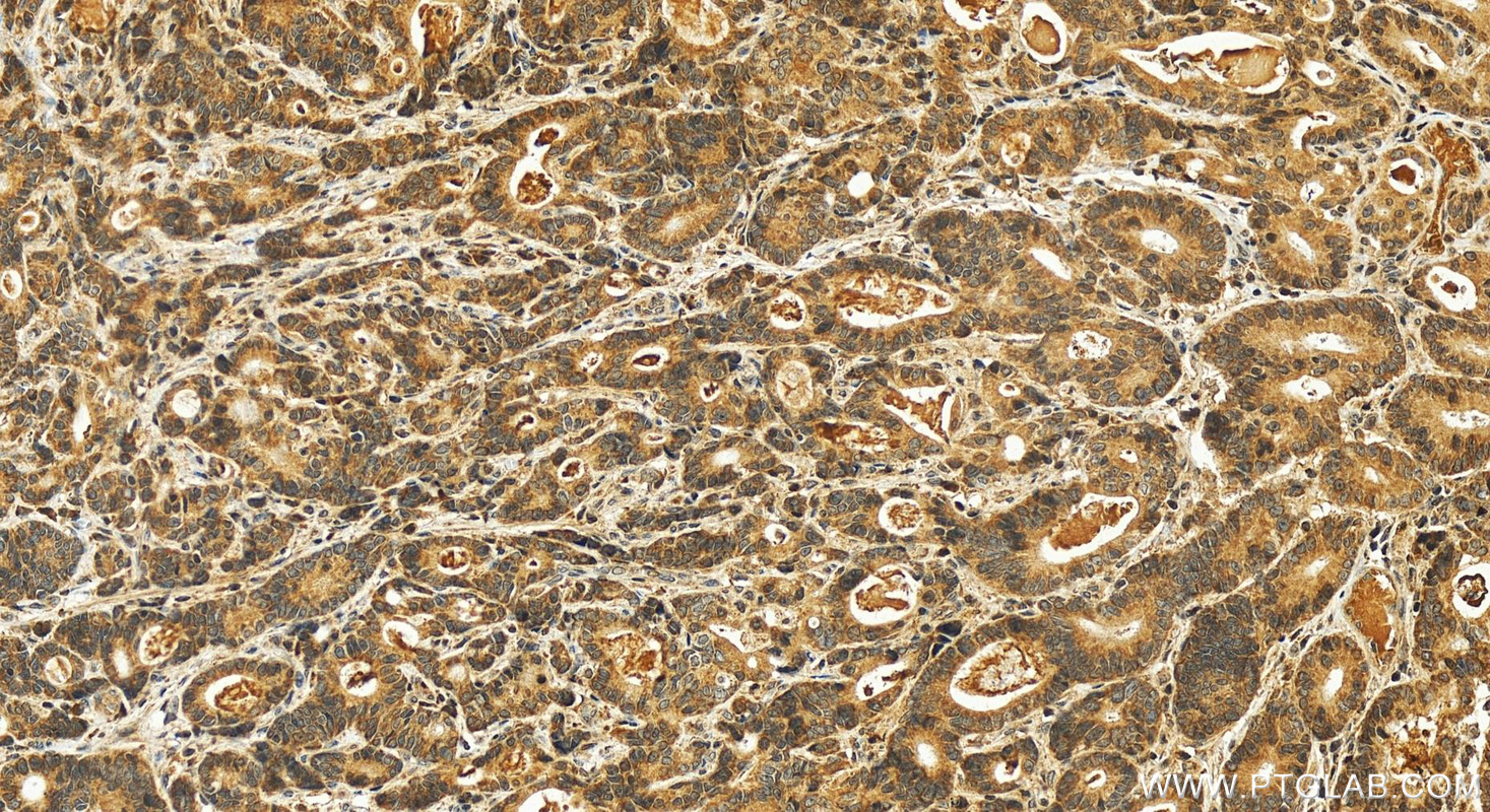 IHC staining of human stomach cancer using 12253-1-AP