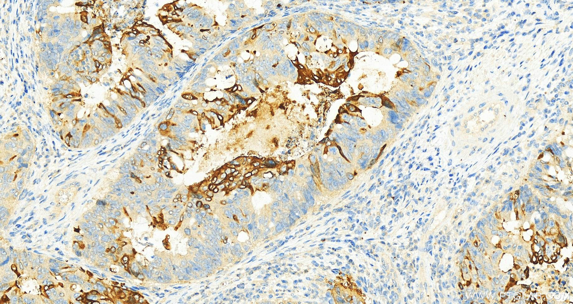 IHC staining of human colon cancer using 13165-1-AP