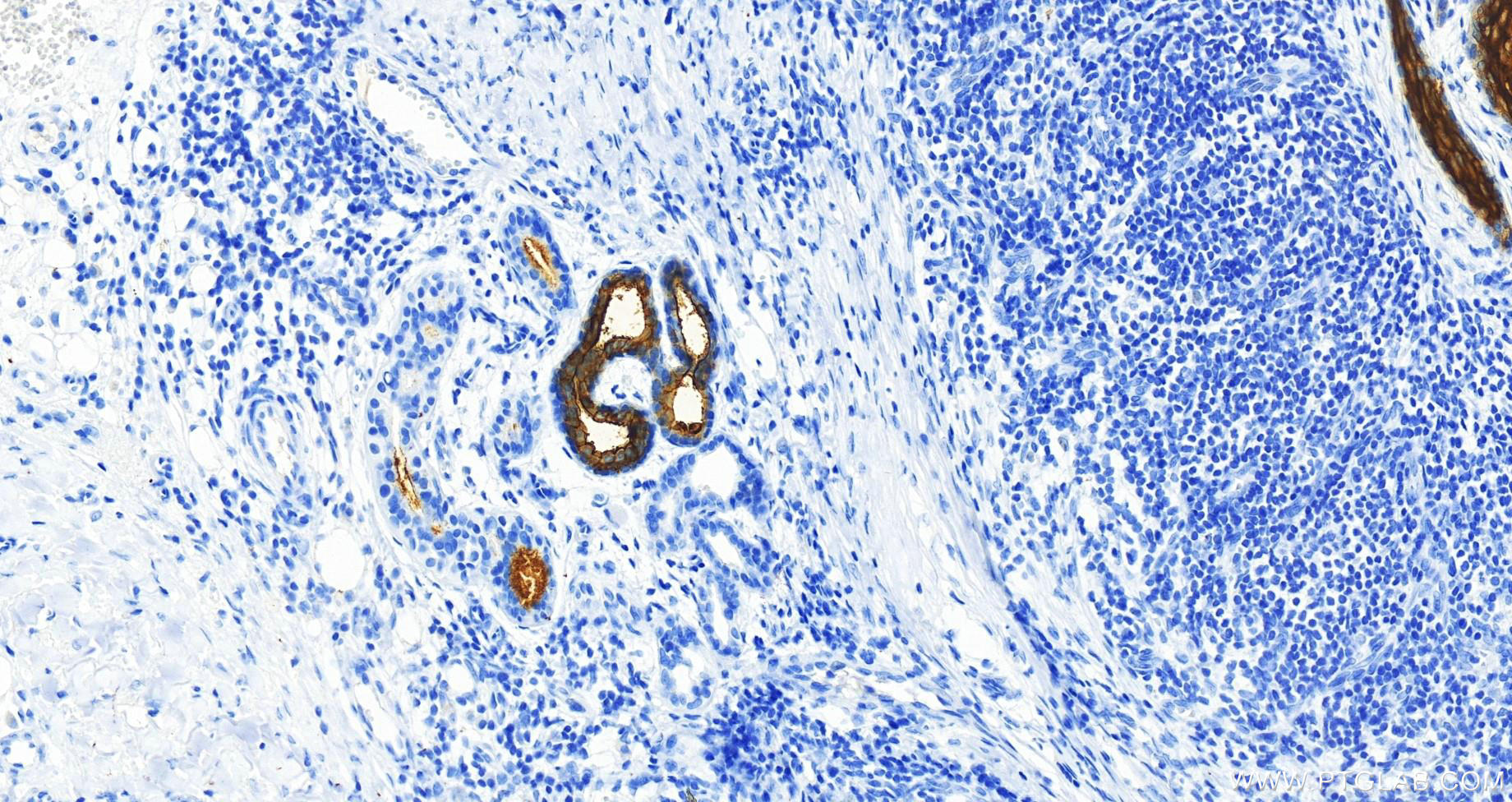 IHC staining of human skin cancer using 81463-1-RR (same clone as 81463-1-PBS)