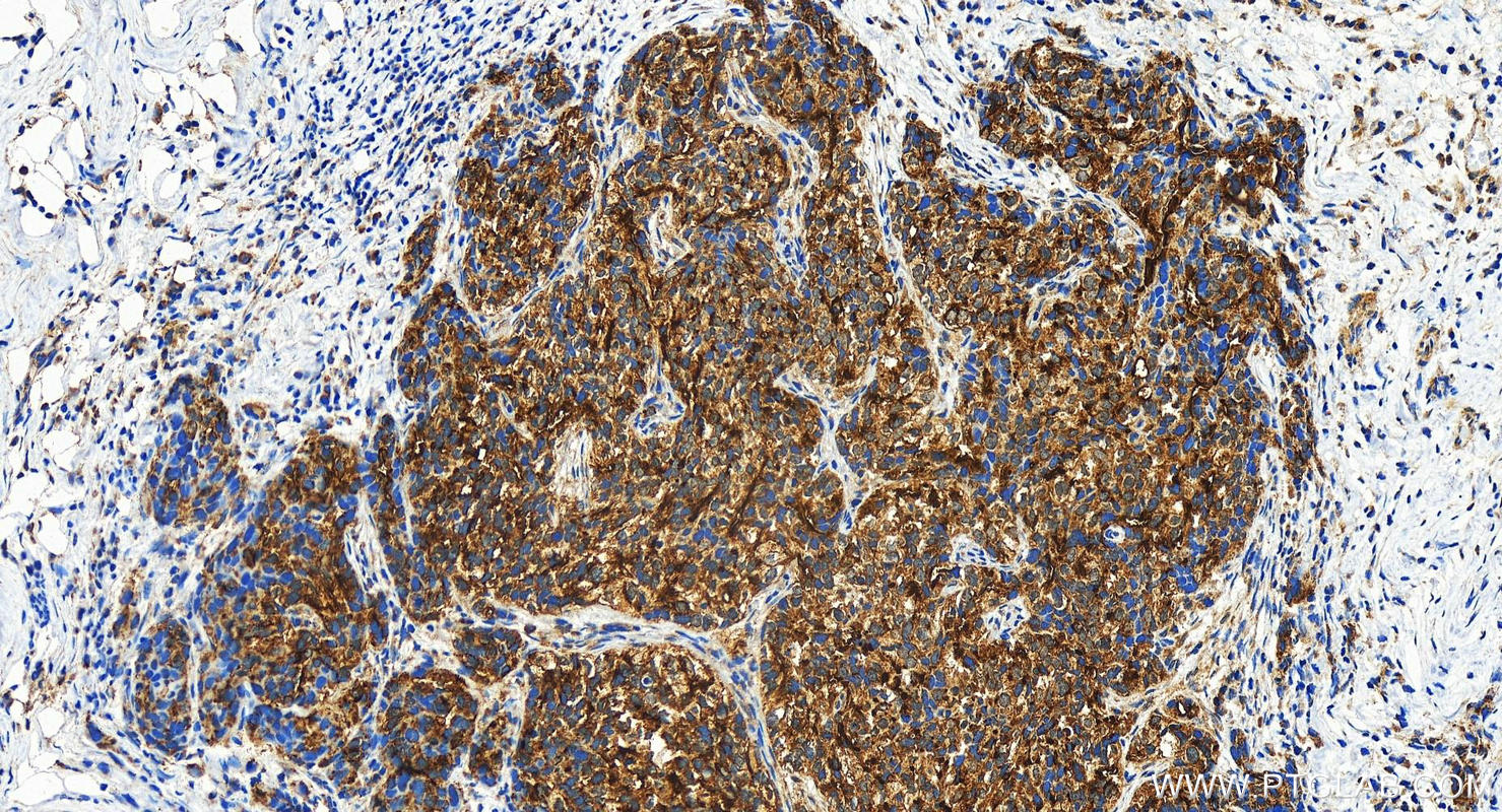 IHC staining of human ovary cancer using 21295-1-AP