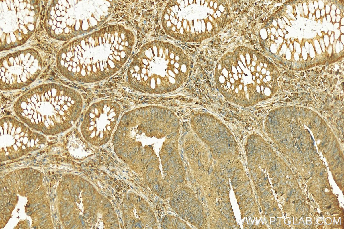 IHC staining of human colon cancer using 17285-1-AP