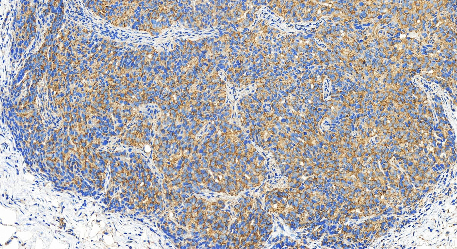 IHC staining of human ovary cancer using 20131-1-AP