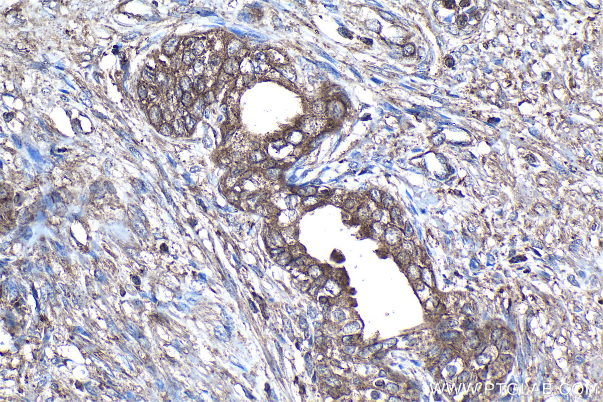 IHC staining of human prostate cancer using 60343-1-Ig